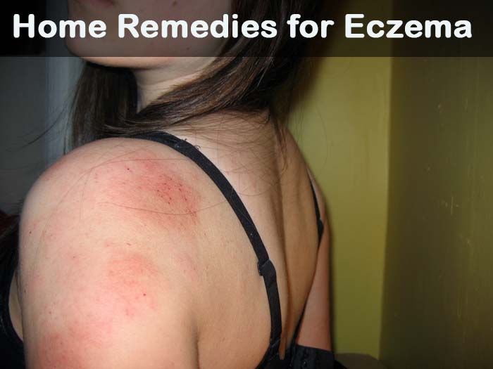 14 Inicio de bricolaje remedios para Eczema
