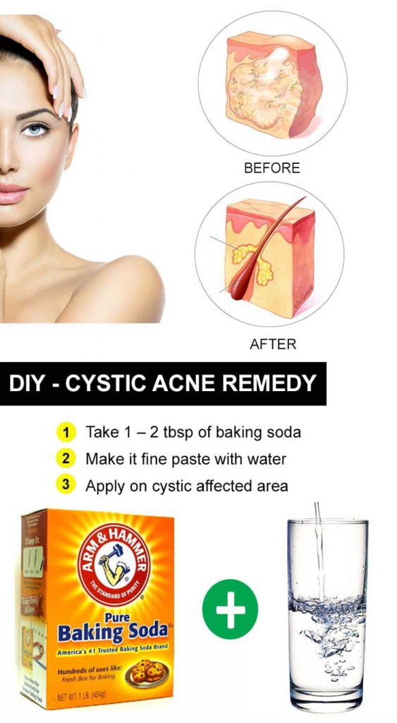 15 Inicio de bricolaje Remedios caseros para el acné quístico