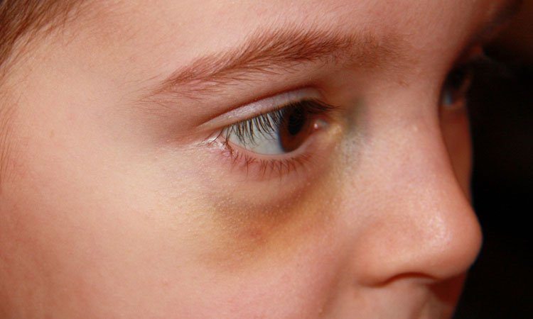15 Remedios caseros para deshacerse de Negro de ojos