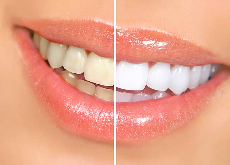 16 DIY Formas naturales para blanquear los dientes