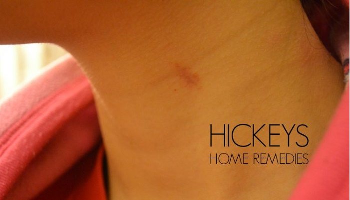 17 DIY Remedios caseros para Hickeys