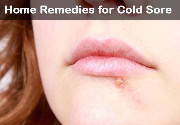 18 DIY Remedios caseros para el herpes labial