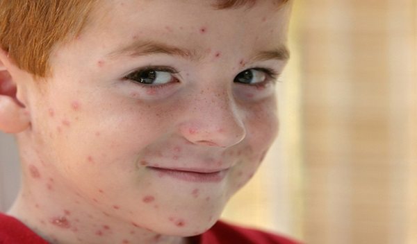 19 Remedios caseros para curar la varicela
