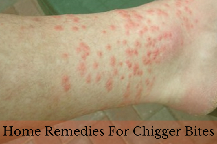 19 mejores remedios caseros para curar Chigger Bites