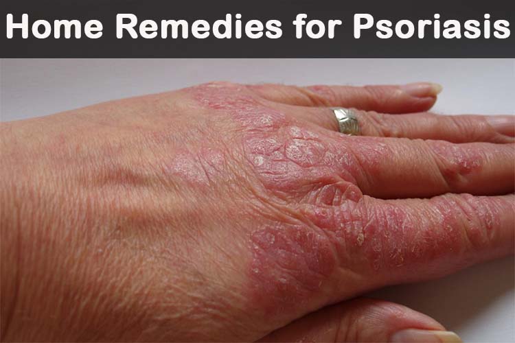 20 DIY Remedios caseros para la psoriasis