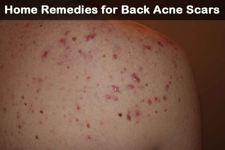 21 DIY Remedios caseros para el acné trasero Cicatrices