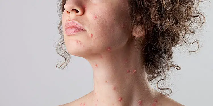 21 DIY Remedios caseros para la varicela
