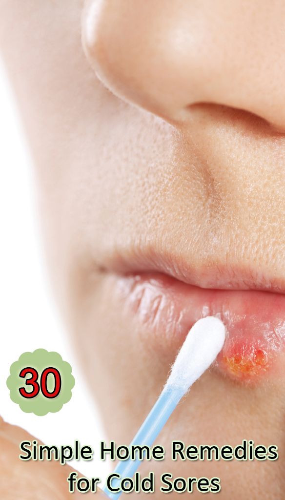 30 simples remedios caseros para el herpes labial