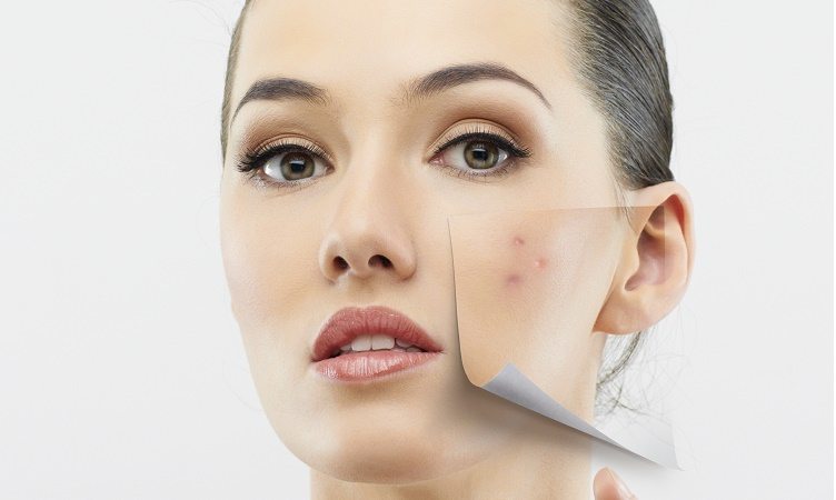 37 DIY Remedios caseros para el acné