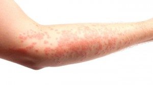 Cómo deshacerse de Eczema Fast: 12 Ways