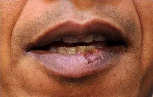 Cómo deshacerse de herpes labial rápido y alojamiento: 16 Pasos