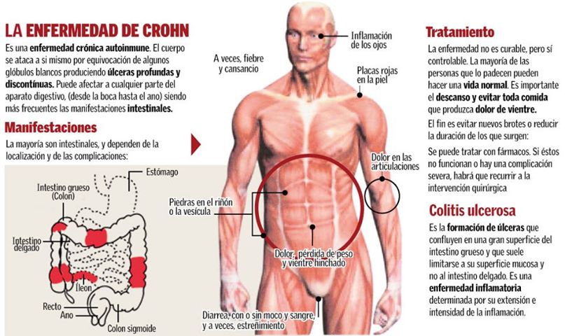 Los fundamentos de la enfermedad de Crohn