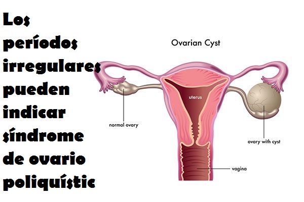Los períodos irregulares pueden indicar síndrome de ovario poliquístico