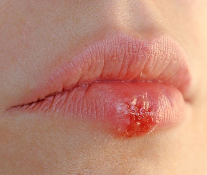 Los principales orígenes de sus labios hinchados