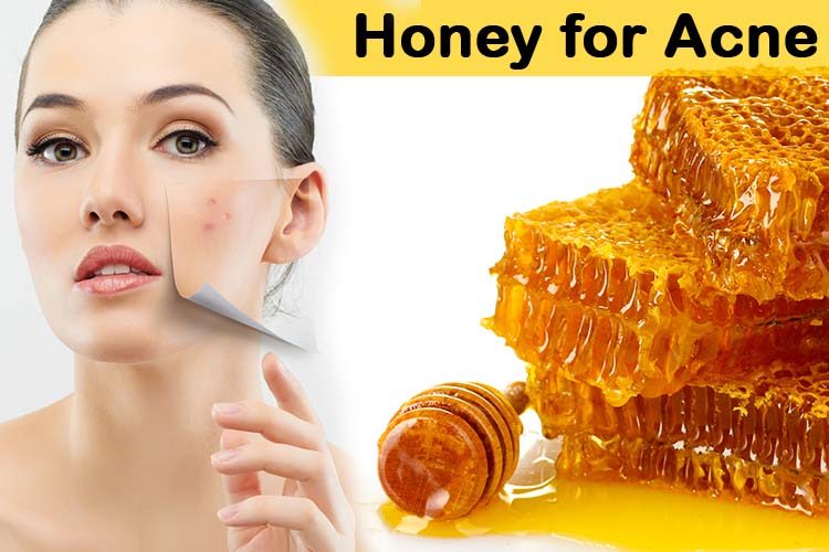 Miel para el acné