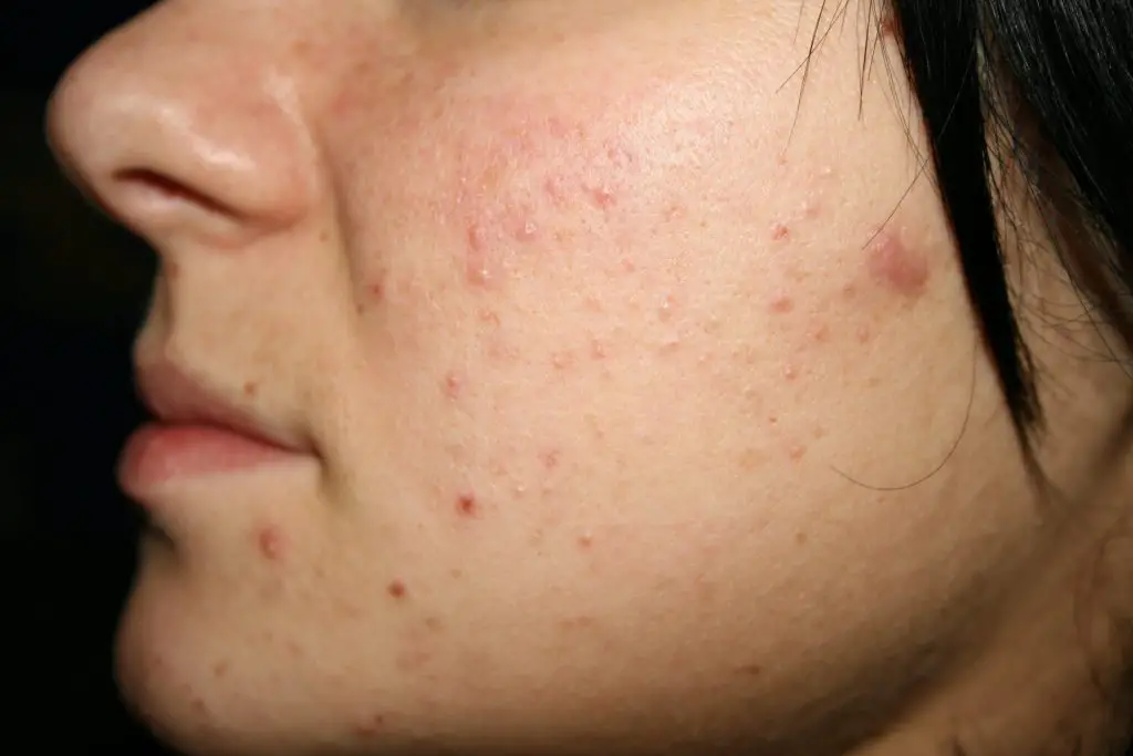 Mis pequeños puntos negros la manera de deshacerse de acné sin problemas y preocuparse