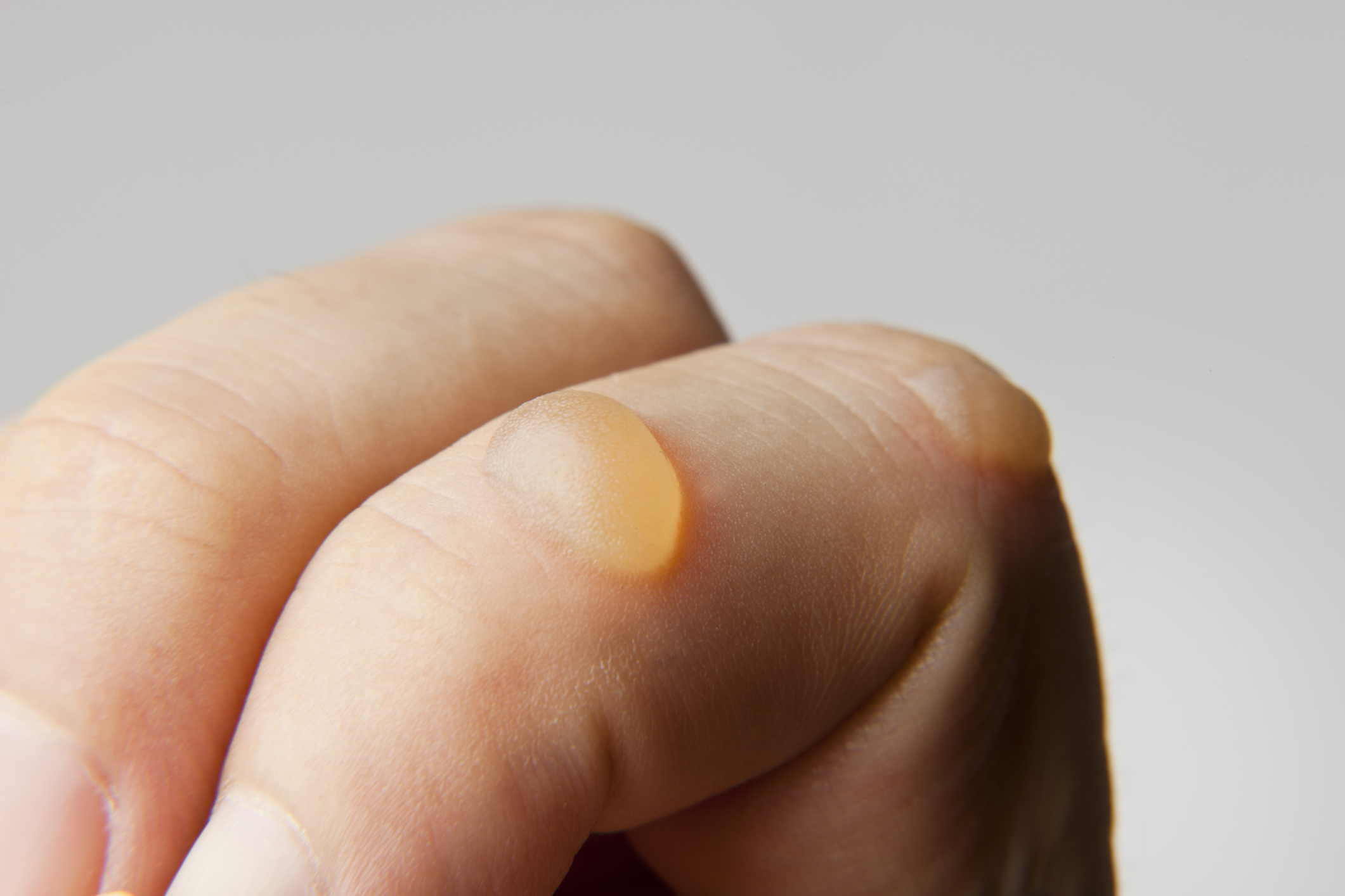human finger blister