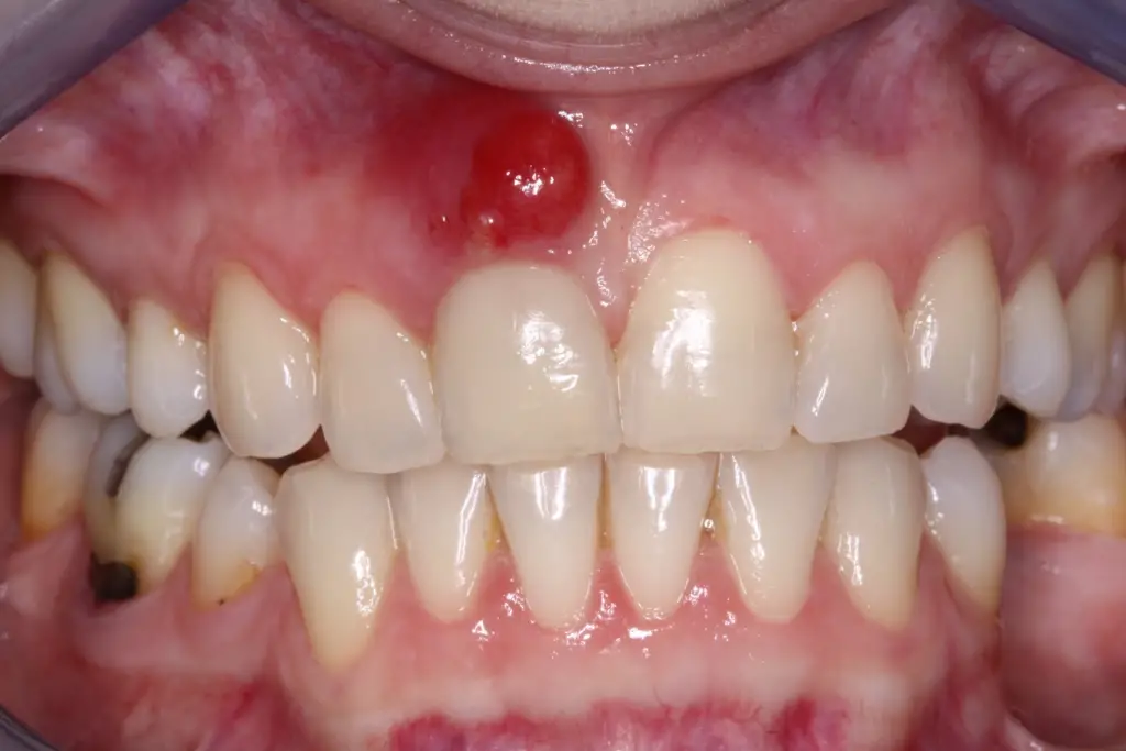 11 Remedios caseros para el absceso dental