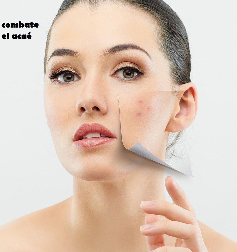 combate el acné