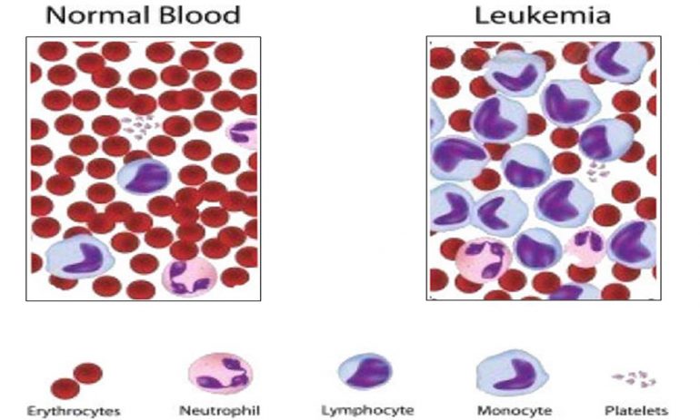 Cómo afecta la leucemia al cuerpo