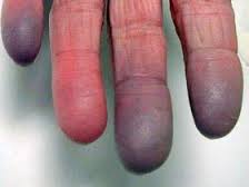 Mala circulación en los dedos