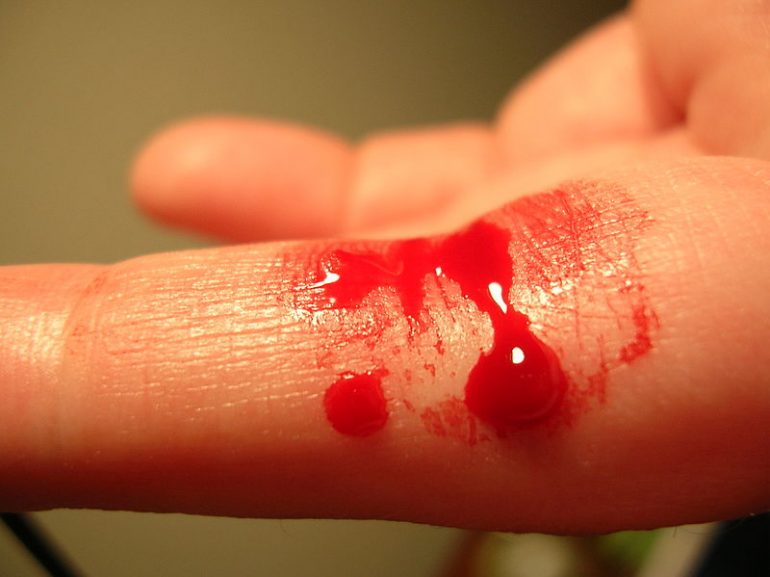 cómo-parar-sangrar...