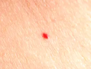 pinpoint red dots on skin cancer