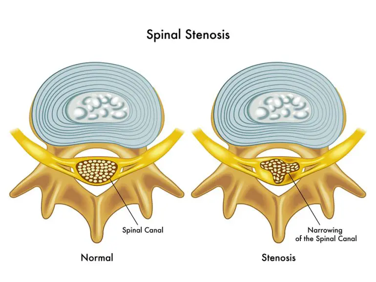 Cirugía de estenosis espinal