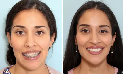 Cirugía de mandíbula antes y después