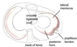 Cuerno posterior del menisco medial