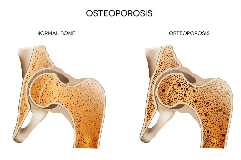 Cómo prevenir la osteoporosis