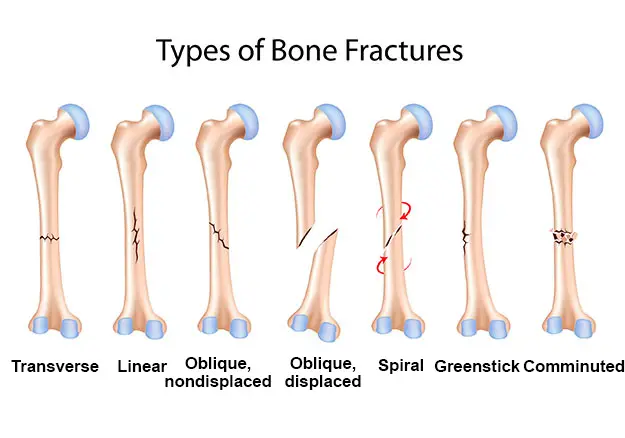 Diferentes tipos de fracturas