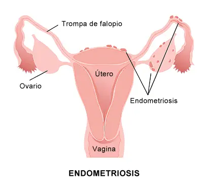 Endometriosis después de la histerectomía
