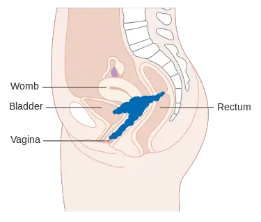 Etapa 3 Cáncer de cuello uterino