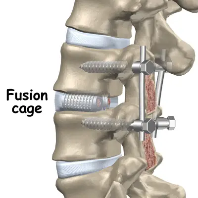 Fusión espinal Recuperación