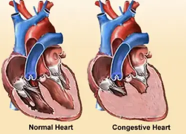 insuficienta cardiaca congestiva