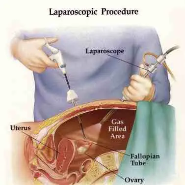 Laparoscopia Endometriosis