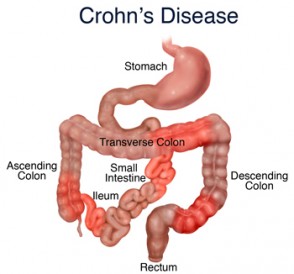 Medicamentos para la enfermedad de Crohn