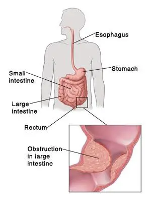 Obstrucción intestinal grande