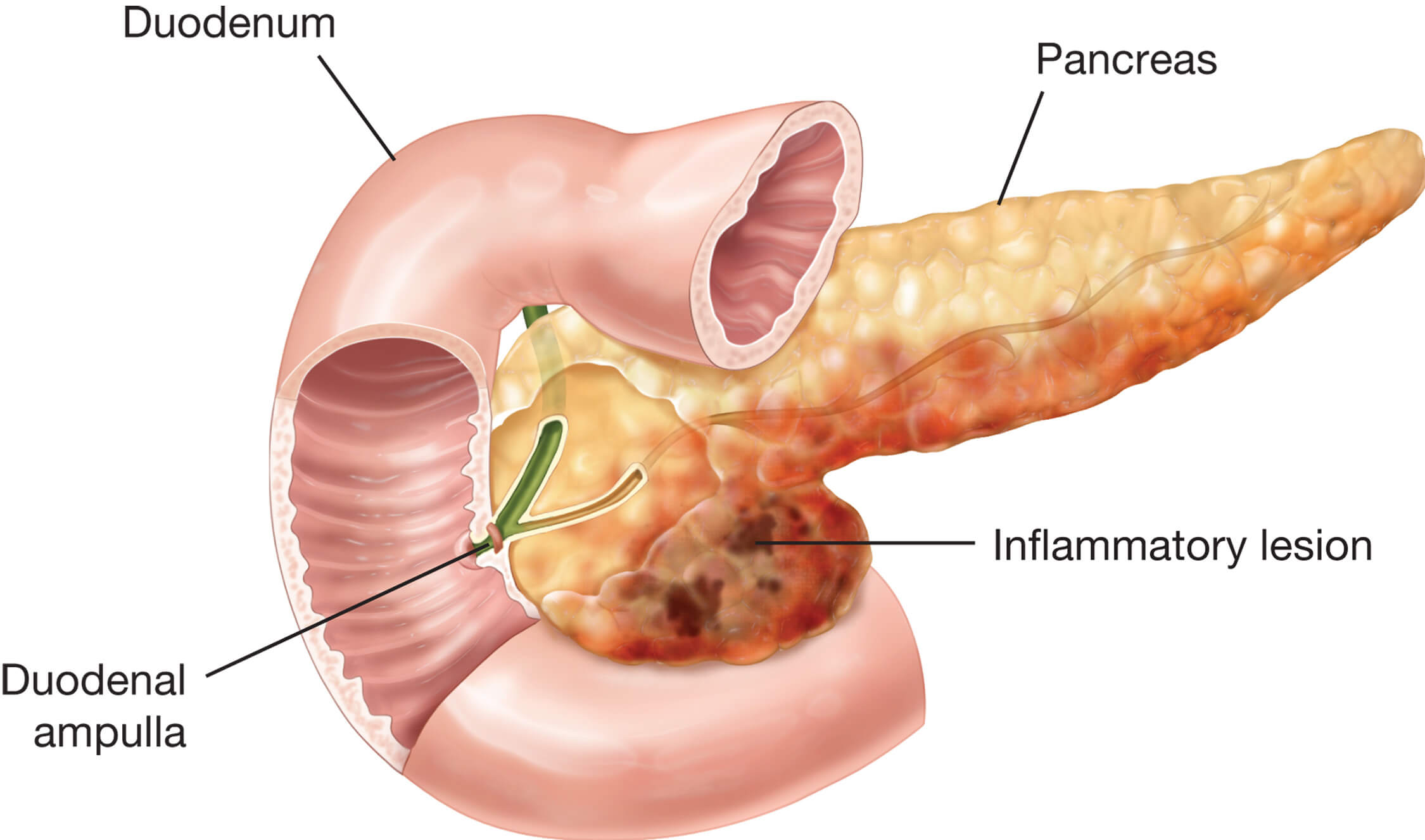 Pancreatitis crónica