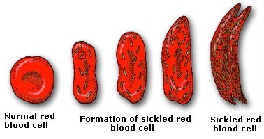 Qué causa la anemia de células falciformes