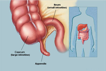 Qué causa la apendicitis
