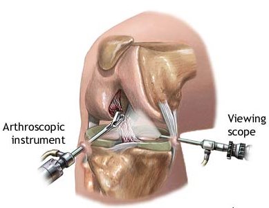 Recuperación artroscópica de la cirugía de rodilla