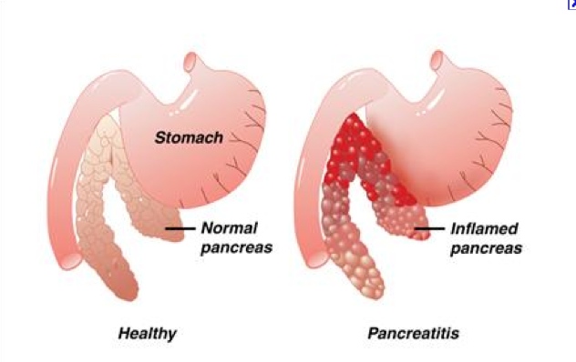 Síntomas de Pancreatitis