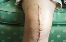 complicaciones de reemplazo de rodilla