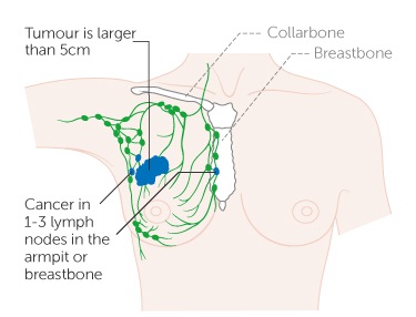 cáncer de mama en los ganglios linfáticos