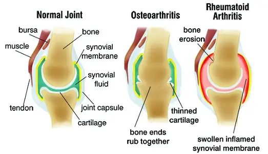 osteoartritis vs artritis reumatoide