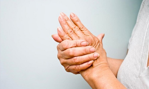 puede la artritis reumatoide matarte