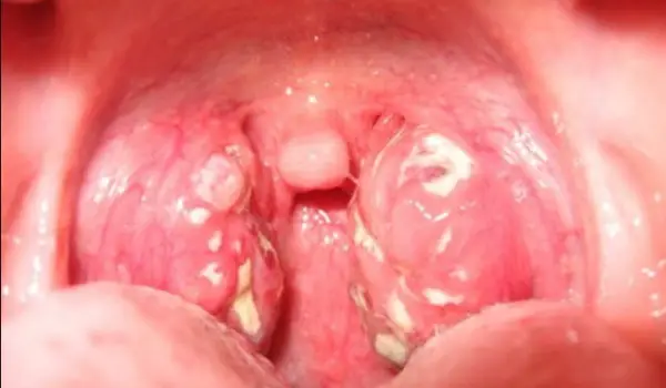 Acumulación de mucosidad en la garganta