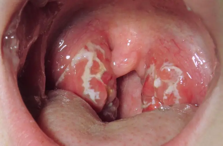 Complicaciones estreptocócicas en la garganta